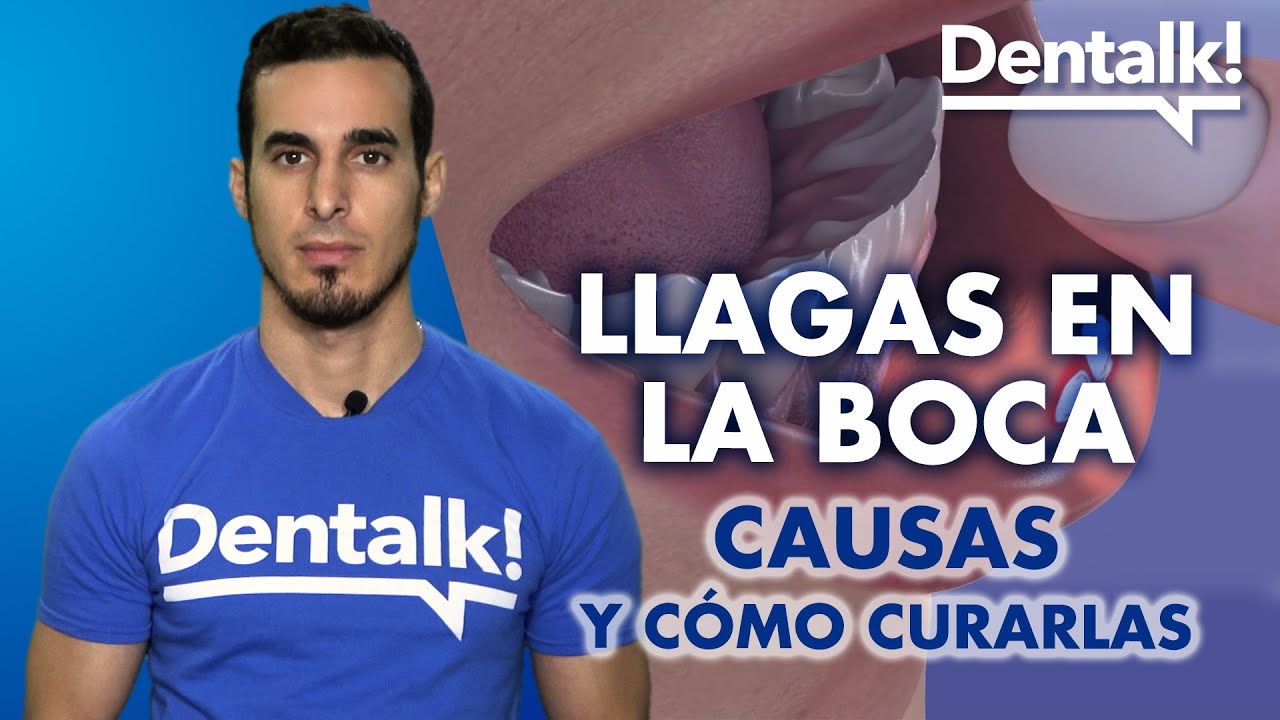llagas debajo de la lengua causas