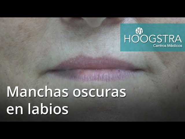 mancha violácea en el labio inferior