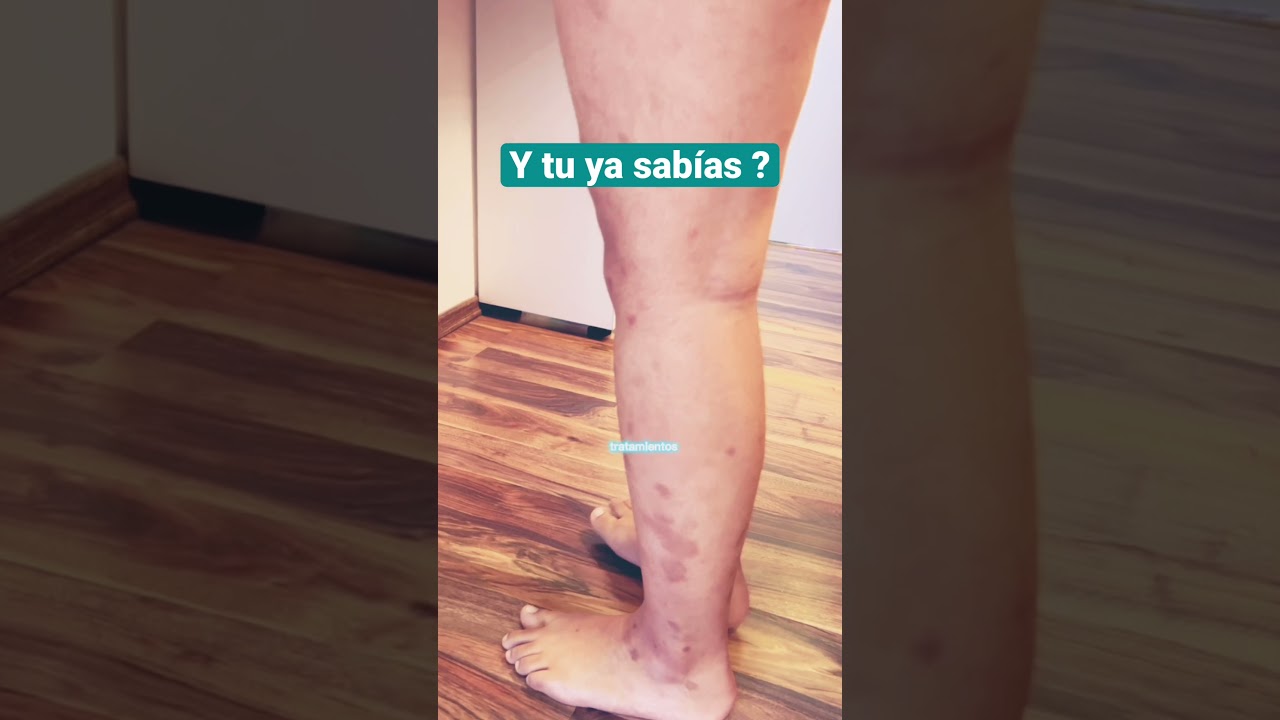 manchas rojas en las piernas sin picor ni dolor