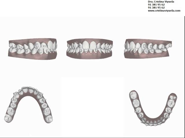 mordida cruzada invisalign antes y despues