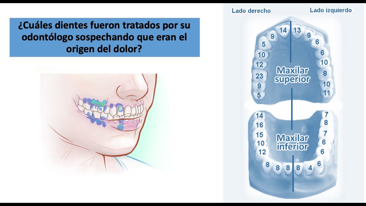 neuralgia del trigémino por infección dental
