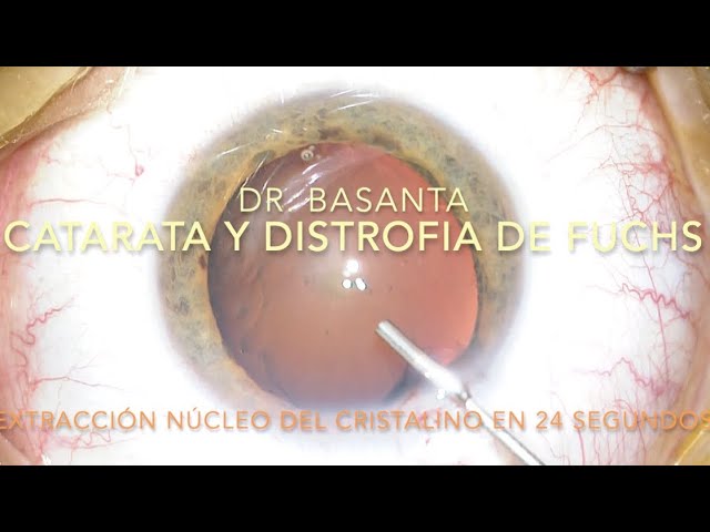 operar cataratas con distrofia de fuchs