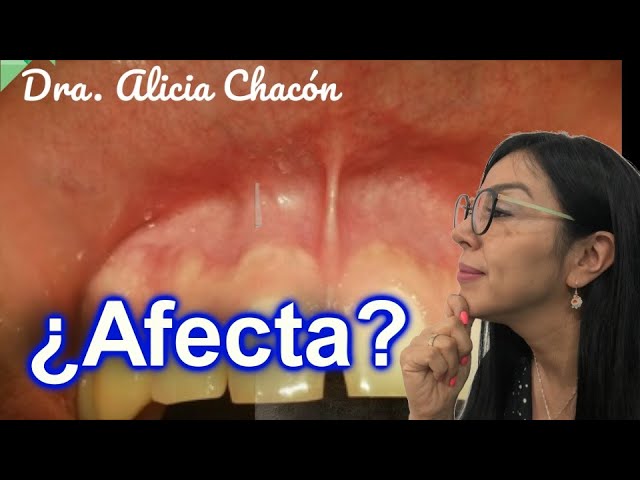 para que sirve el frenillo de la boca