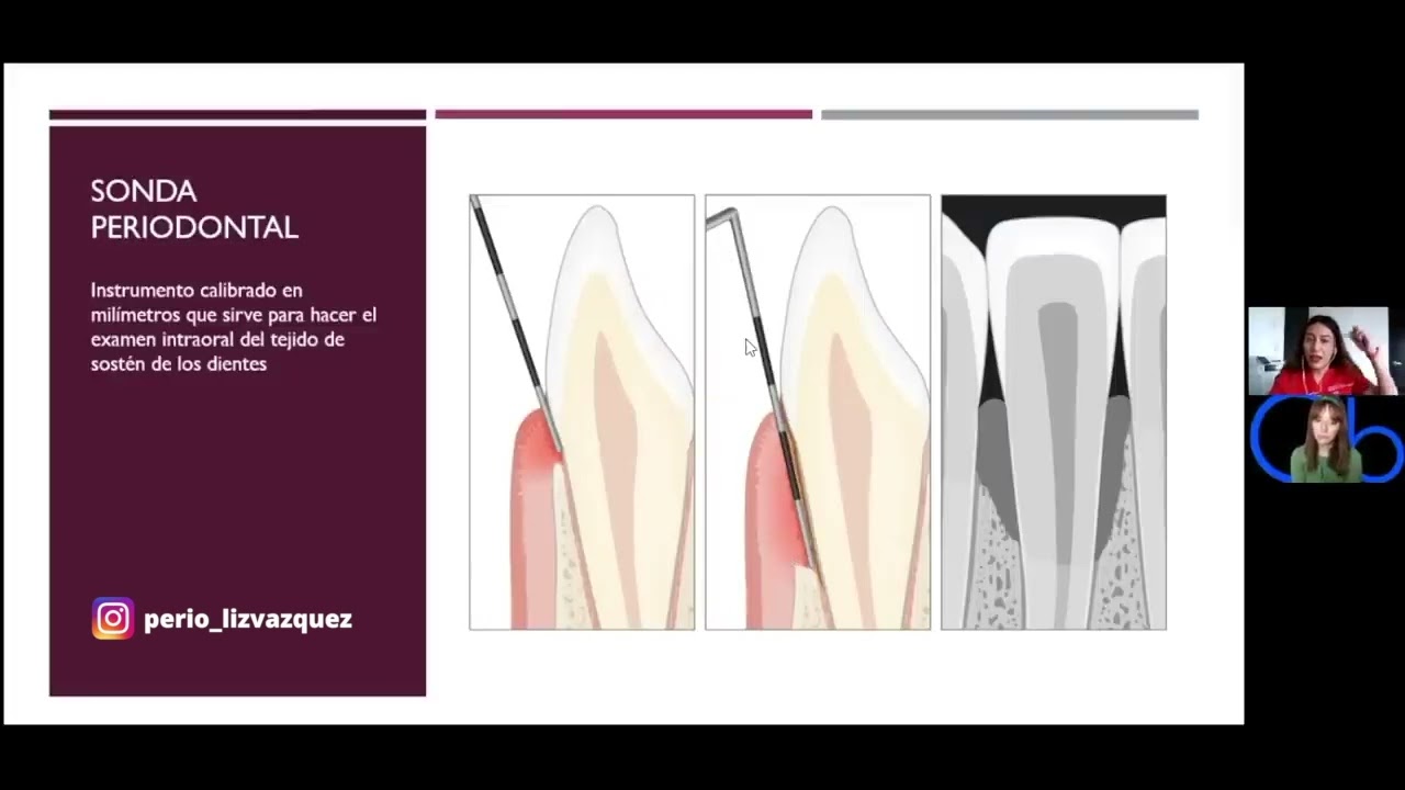 para que sirve la sonda periodontal