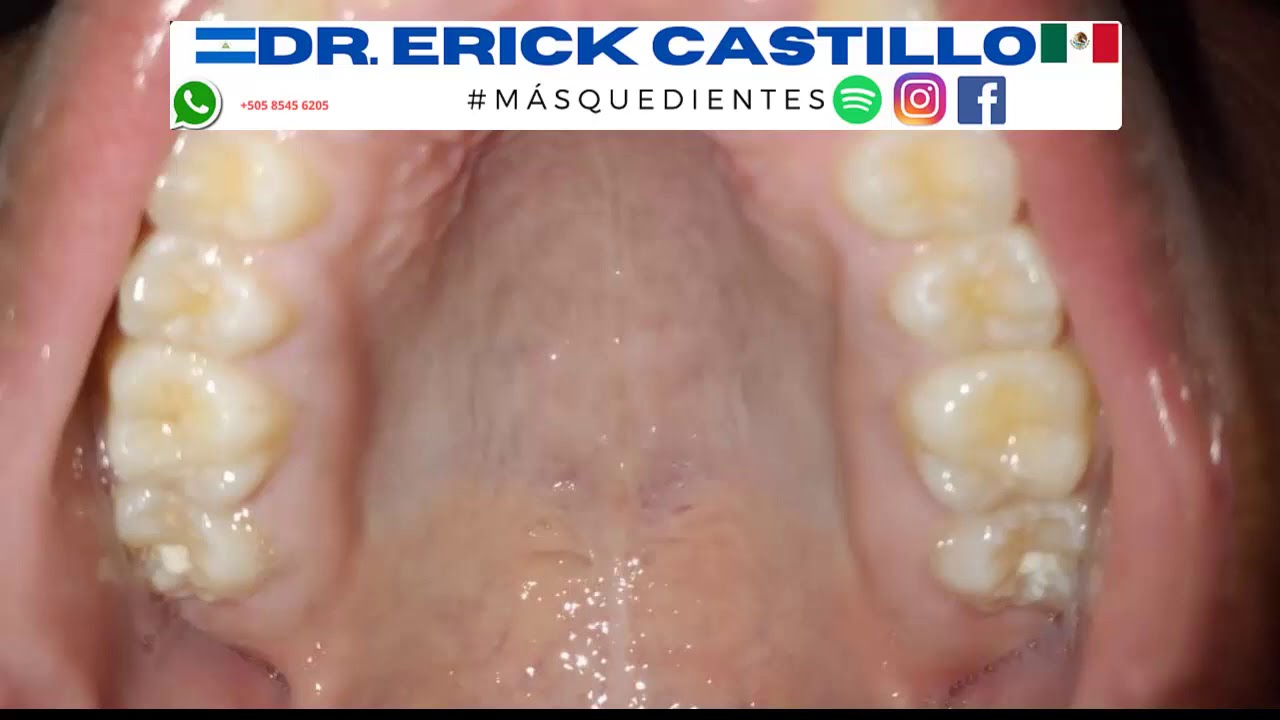 por qué tengo el paladar amarillo