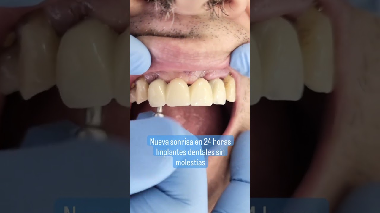 prótesis dental fija antes y después