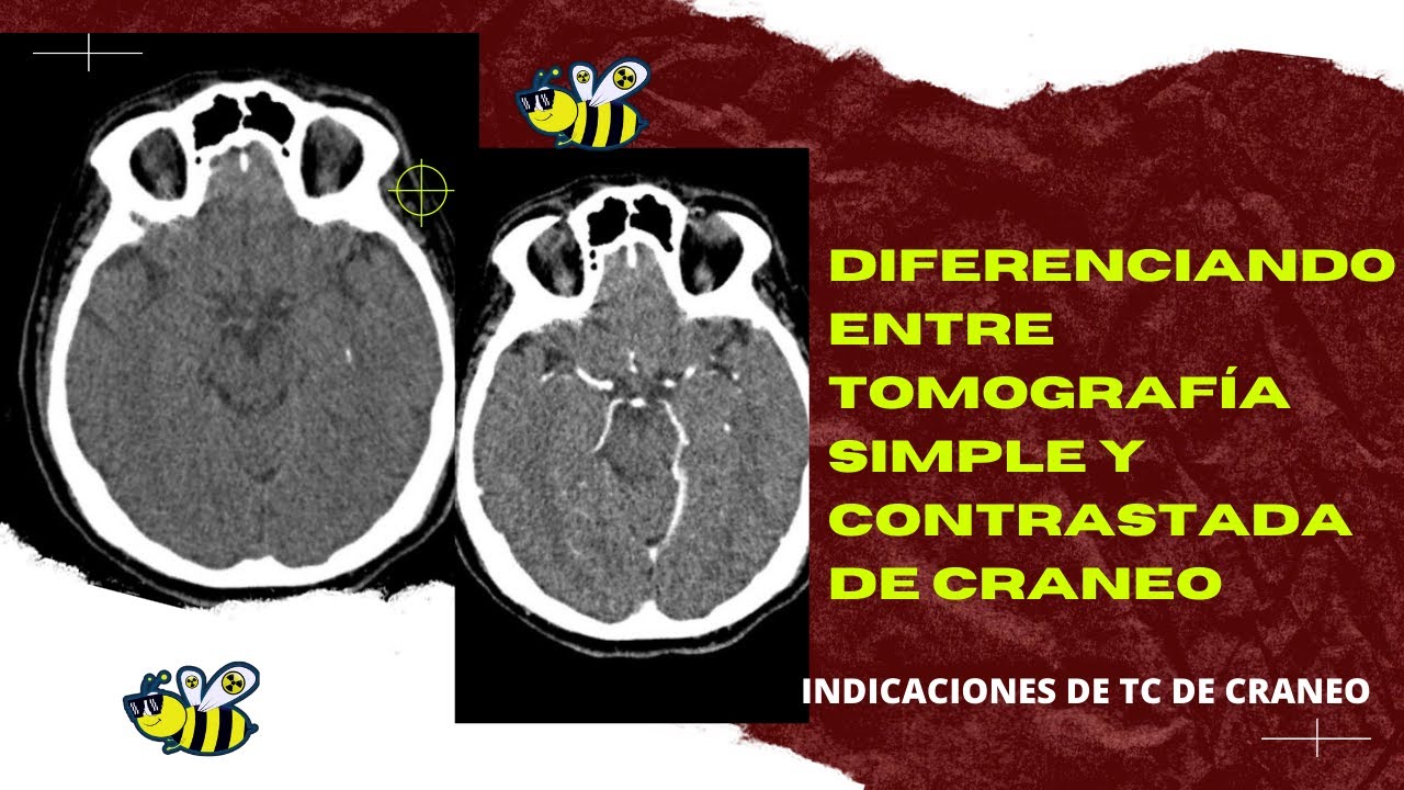 que se ve en un tac craneal sin contraste