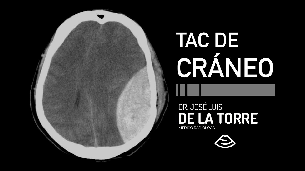 que se ve en un tac de cabeza