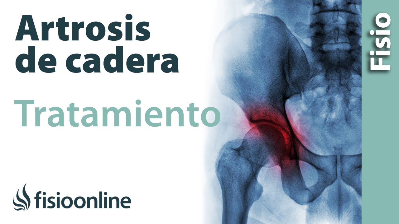 que tomar para la artrosis de cadera