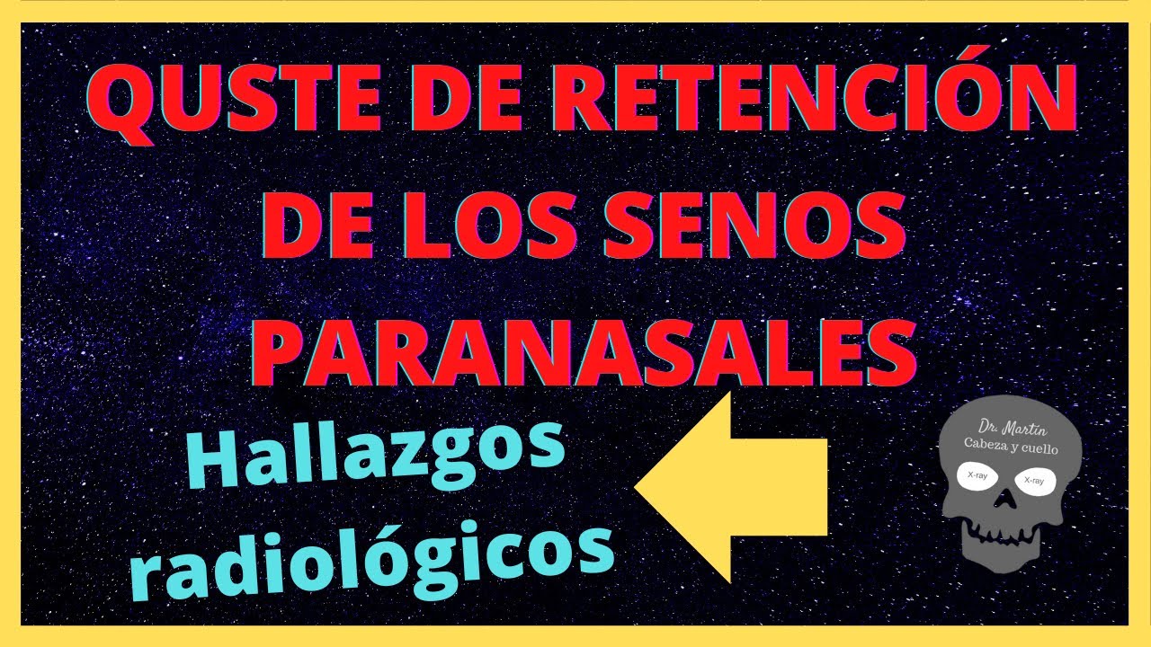 quiste seno maxilar y dolor de cabeza