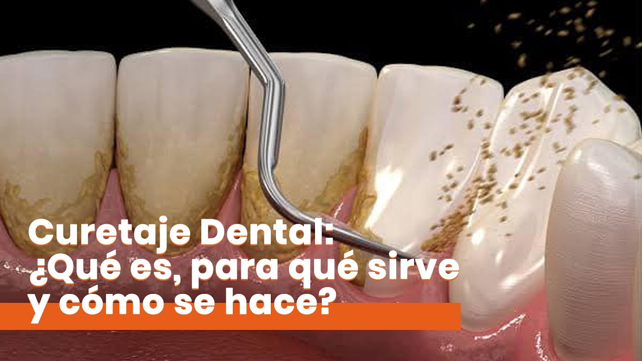 raspaje y alisado radicular por cuadrante