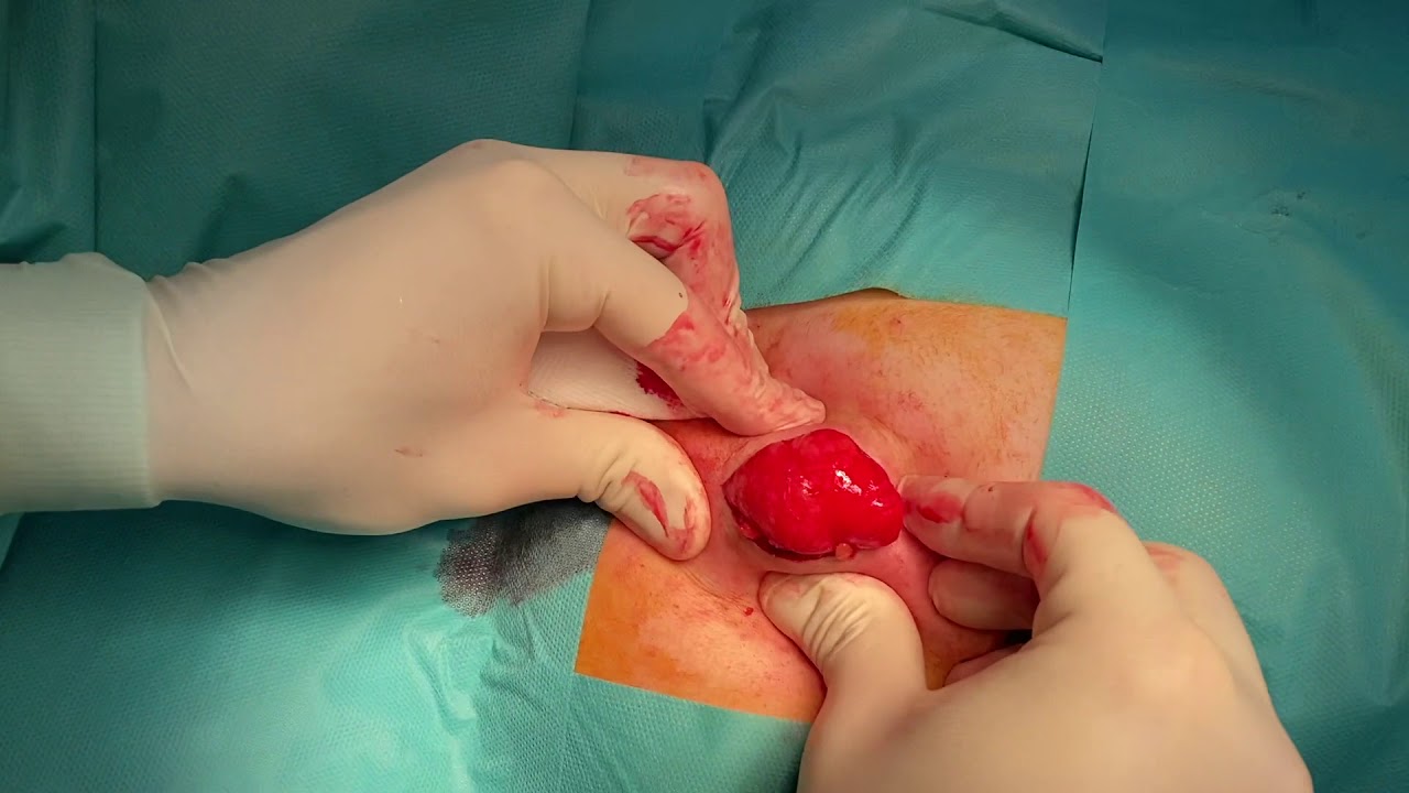 recuperación después de una cirugía de lipoma