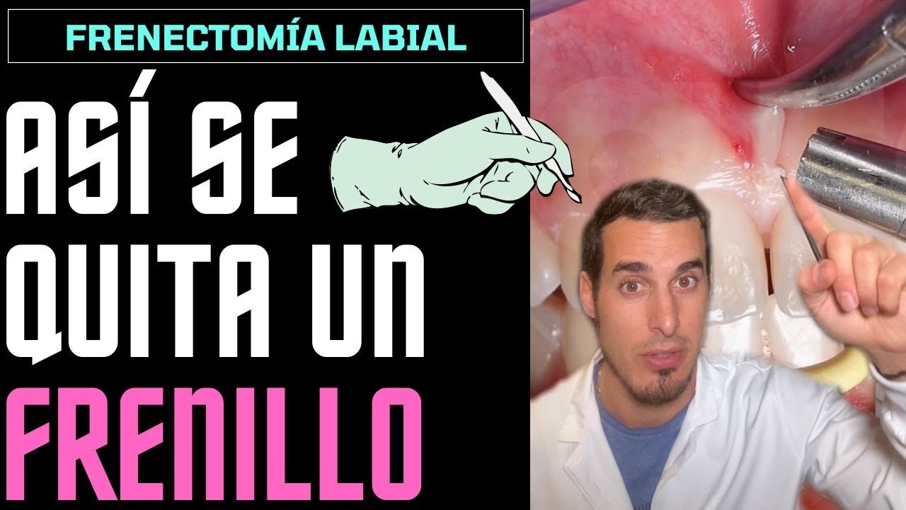 rotura del frenillo del labio superior