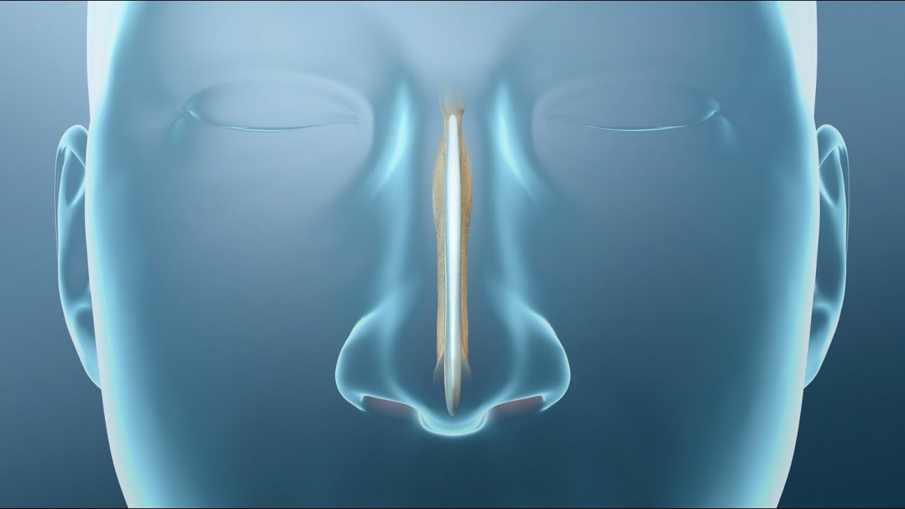 septoplastia y cornetes tiempo de baja