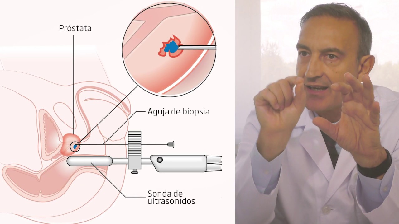 subida del psa después de prostatectomía