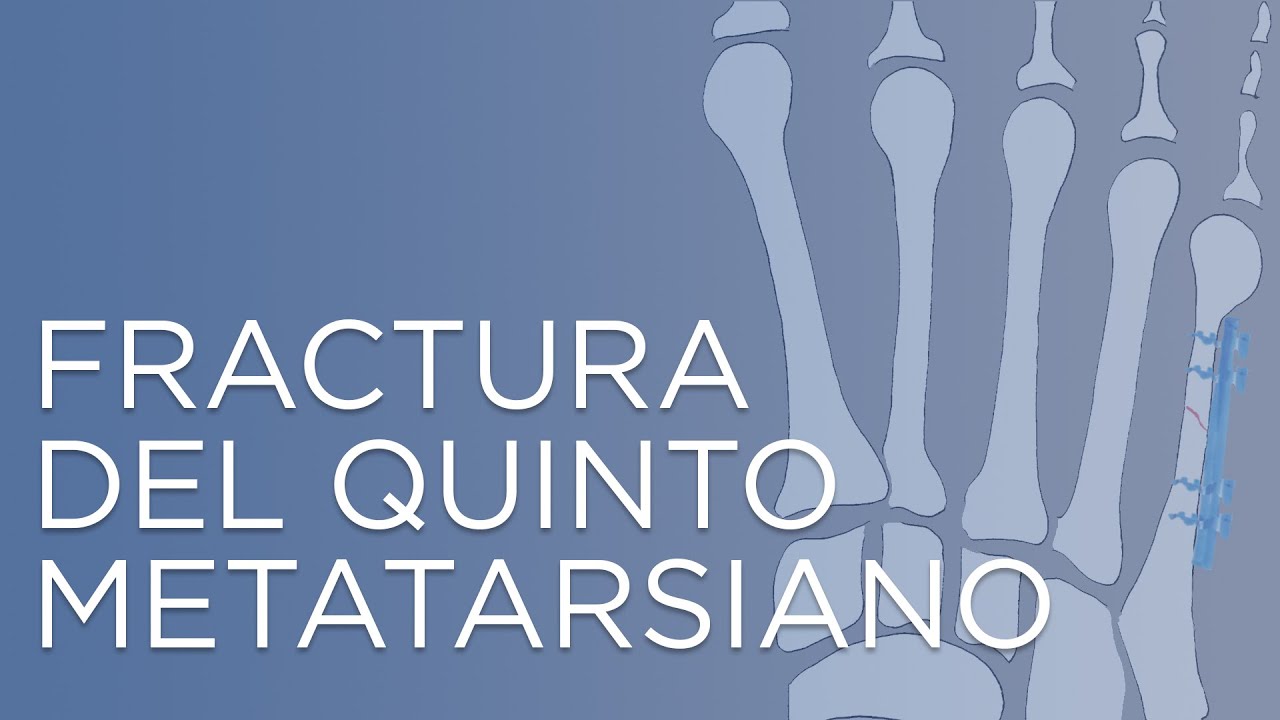 tiempo de baja fractura quinto metatarsiano