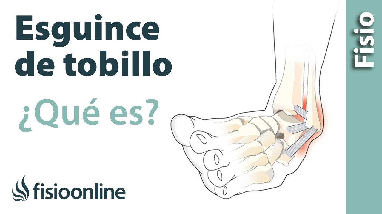 tipos de esguince en el pie
