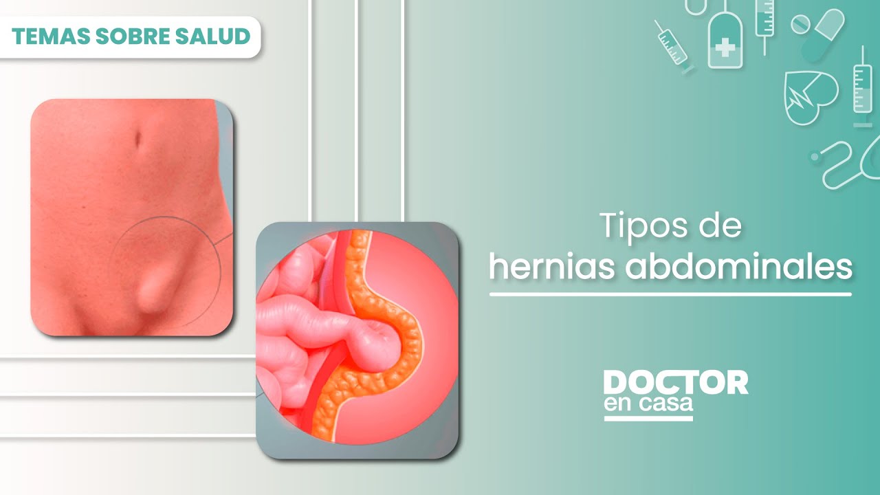 tipos de hernias en el abdomen