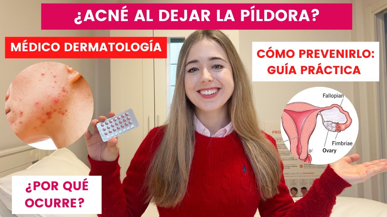 tratamiento acné después de dejar la píldora