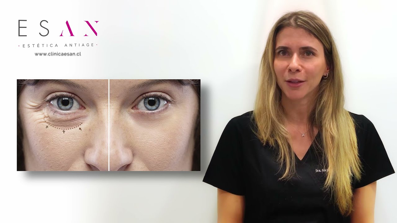 tratamiento de ojeras con acido hialuronico